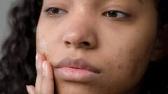 Acne Remedy : முகப்பருக்கள் சட்டுன்னு மறையனுமா? வெங்காயத்தை முகத்தில் இப்படி தடவுங்கள்!