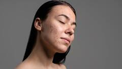 मुहांसों से पाना है छुटकारा तो जानें कैसे करें कच्चा प्याज का चेहरे पर इस्तेमाल