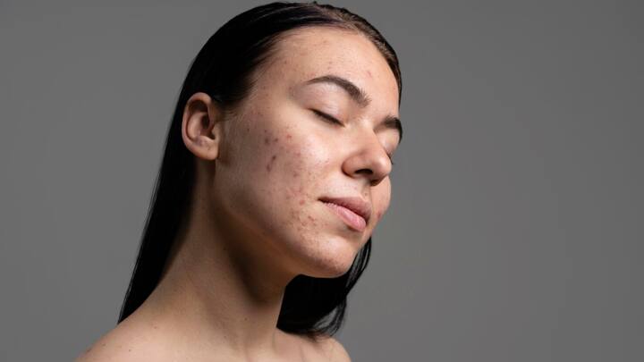 कच्चा प्याज मुहांसों और त्वचा की समस्याओं को दूर करने में भी मददगार है. इसमें सल्फर यौगिक पाया जाता है जो मुहांसों को सूखाने में मदद करता है.