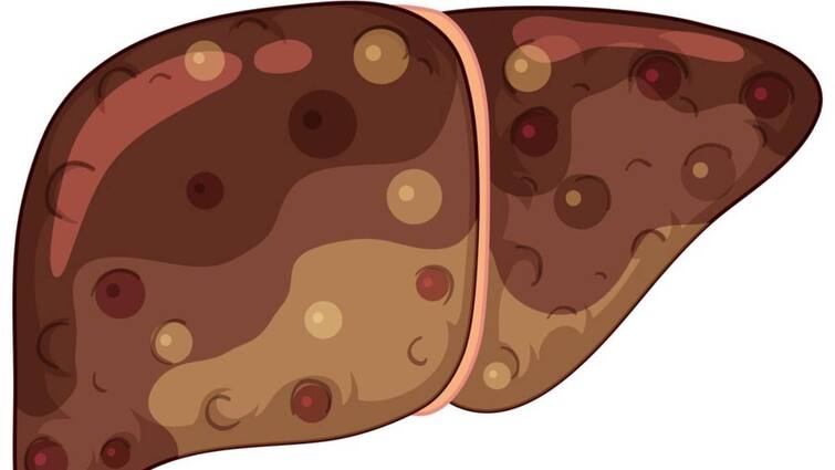 Cirrhosis of the Liver Signs and Symptoms Causes and Stages लिवर हो रहा है डैमेज तो शरीर पर दिखने लगते हैं संकेत, दिक्कत बड़ी होने से पहले ऐसे समझें