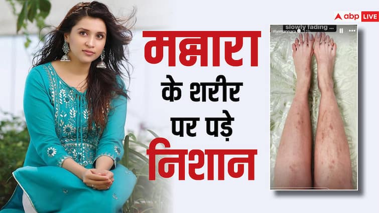 bigg boss 17 mirchi task mannara chopra still have scars on her body  share pics मिर्ची टास्क में Mannara Chopra की हो गई थी हालत खराब, बिग बॉस खत्म होने के 1 महीने बाद भी शरीर पर हैं निशान