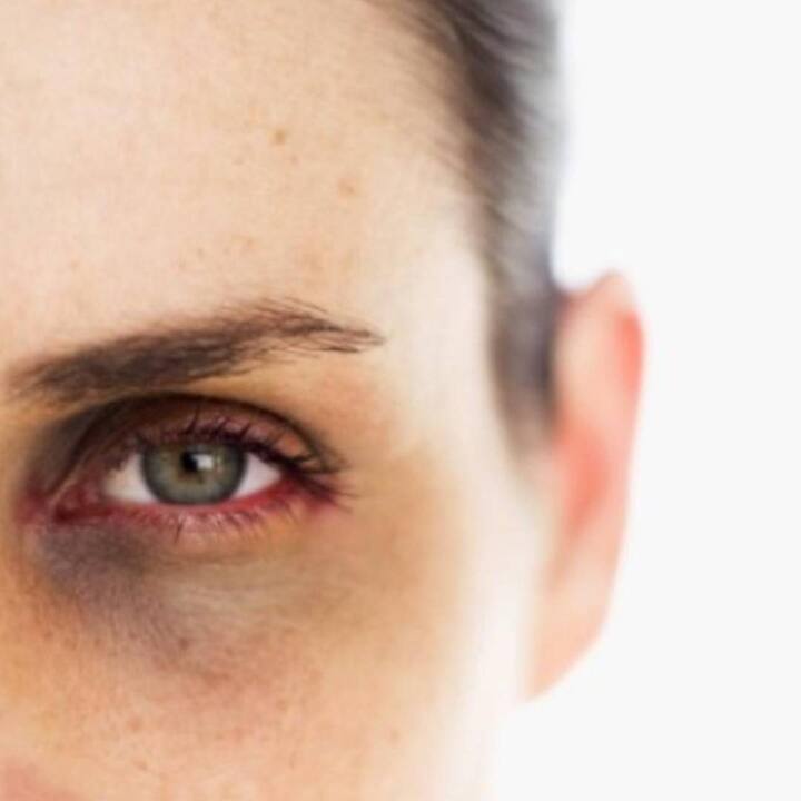 ਜੋ ਲੋਕ ਰਾਤ ਨੂੰ ਜਾਗਦੇ ਰਹਿੰਦੇ ਹਨ, ਉਨ੍ਹਾਂ ਦੀਆਂ ਅੱਖਾਂ ਦੇ ਹੇਠਾਂ ਕਾਲੇ ਘੇਰੇ ਪੈ ਜਾਂਦੇ ਹਨ। ਜਿਸ ਕਾਰਨ ਚਿਹਰਾ ਖਰਾਬ ਨਜ਼ਰ ਆਉਣ ਲੱਗਦਾ ਹੈ। ਇਸ ਤੋਂ ਬਚਣ ਲਈ ਅੱਜ ਤੋਂ ਹੀ ਸਮੇਂ 'ਤੇ ਸੌਣ ਦੀ ਆਦਤ ਬਣਾਓ।