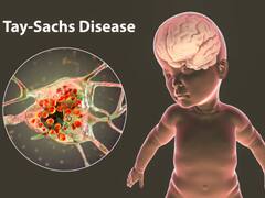 Sickle Cell Anaemia To Lysosomal Storage Disorders: 10 Rare Diseases In Children