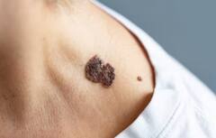 Skin Cancer: ਸਰੀਰ 'ਤੇ ਨਜ਼ਰ ਆਉਣ ਵਾਲੇ ਇਹ ਬਦਲਾਅ ਹੋ ਸਕਦੇ ਸਕਿਨ ਕੈਂਸਰ ਦੇ ਲੱਛਣ, ਜਾਣੋ