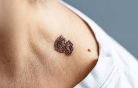 ਇਸ ਨੂੰ ਨਜ਼ਰਅੰਦਾਜ਼ ਕਰਨਾ ਤੁਹਾਡੇ ਲਈ ਖ਼ਤਰਨਾਕ ਹੋ ਸਕਦਾ ਹੈ। ਕਈ ਵਾਰ ਕੈਂਸਰ ਬਾਰੇ ਇੰਨੀ ਦੇਰ ਬਾਅਦ ਪਤਾ ਲੱਗਦਾ ਹੈ ਕਿ ਇਸ ਦਾ ਇਲਾਜ ਕਰਨਾ ਅਸੰਭਵ ਹੋ ਜਾਂਦਾ ਹੈ। ਇਸ ਲਈ, ਇਸ ਦੇ ਲੱਛਣਾ ਬਾਰੇ ਪਤਾ ਹੋਣਾ ਬਹੁਤ ਜ਼ਰੂਰੀ ਹੈ। ਜੇਕਰ ਤੁਸੀਂ ਆਪਣੀ ਚਮੜੀ 'ਚ ਕਿਸੇ ਤਰ੍ਹਾਂ ਦਾ ਬਦਲਾਅ ਦੇਖਦੇ ਹੋ, ਤਾਂ ਪਹਿਲਾਂ ਉਸ ਦੇ ਕਾਰਨ ਦਾ ਪਤਾ ਲਗਾ ਲਓ।