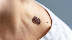 Skin Cancer: शरीर पर दिखने वाले ये मामूली बदलाव हो सकते हैं स्किन कैंसर के लक्षण