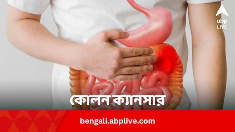 Why are young people prone to colon cancer Cancer: তরুণদের মধ্যে বাড়ছে কোলন ক্যানসার ! নেপথ্যে কী কারণ ?