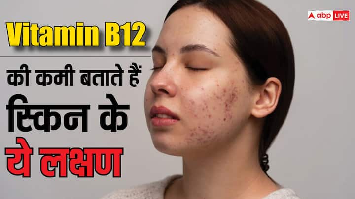 health tips vitamin b12 deficiency signs on skin in hindi अगर स्किन पर हो रहे हैं ये बदलाव तो वो थकान से नहीं, इस विटामिन की कमी से है! ऐसे करें ठीक