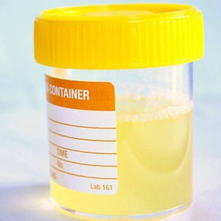 ਜੇਕਰ ਤੁਹਾਡਾ ਪਿਸ਼ਾਬ ਬੱਦਲਵਾਈ ਵਾਲਾ ਹੈ ਤਾਂ ਸ਼ਾਇਦ ਤੁਹਾਨੂੰ ਕਿਡਨੀ ਦੀ ਕੋਈ ਸਮੱਸਿਆ ਹੈ ਇਸ ਤੋਂ ਇਲਾਵਾ ਕਈ ਵਾਰ ਪਿਸ਼ਾਬ ਵਿੱਚ ਵੀਰਜ ਮਿਲ ਜਾਂਦਾ ਹੈ ਜਿਸ ਕਾਰਨ ਇਹ ਇਸ ਰੰਗ ਦਾ ਹੋ ਜਾਂਦਾ ਹੈ