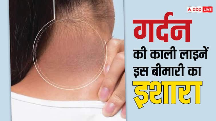 health tips acanthosis nigricans causes and signs neck dark lines reasons in hindi गर्दन पर कालापन आए तो हल्के में न लें, हो सकते हैं गंभीर बीमारी के संकेत