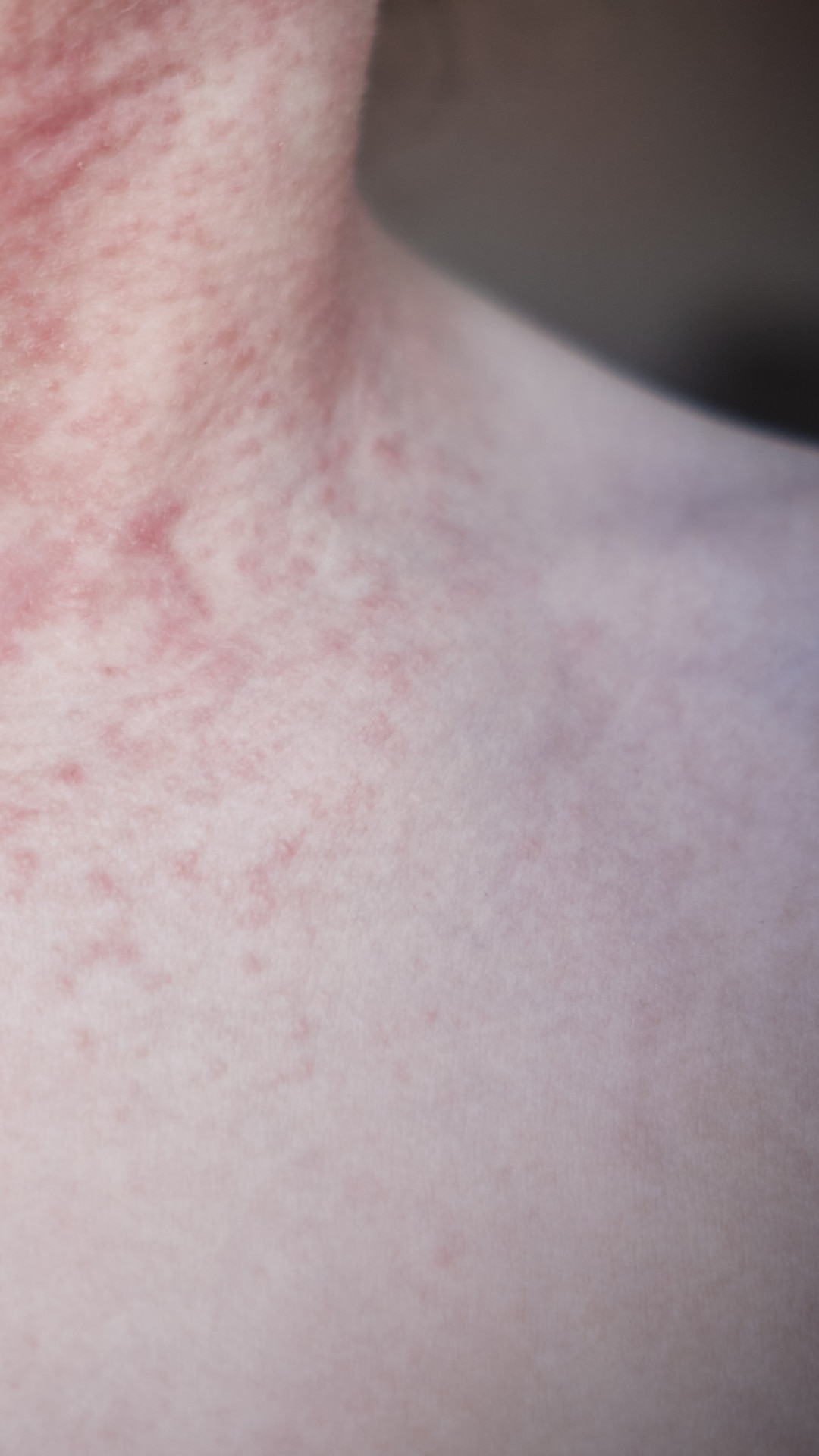Childhood Rashes: