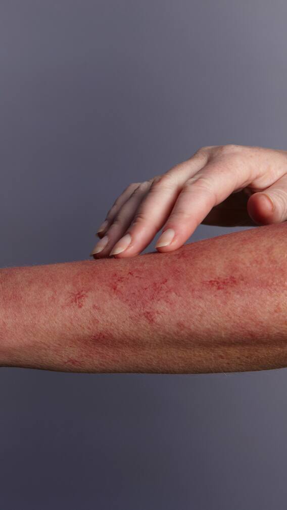 Dermatomyosytis: Know Signs And Symptoms To Watch Out For