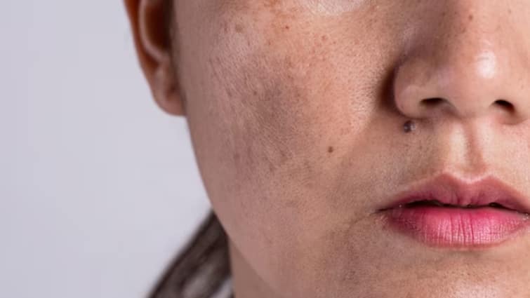 Use of mulethi to reduce hyperpigmentation चेहरे की छाइयां नहीं ले रहीं खत्म होने का नाम, तो मुलेठी को इस तरह करें इस्तेमाल
