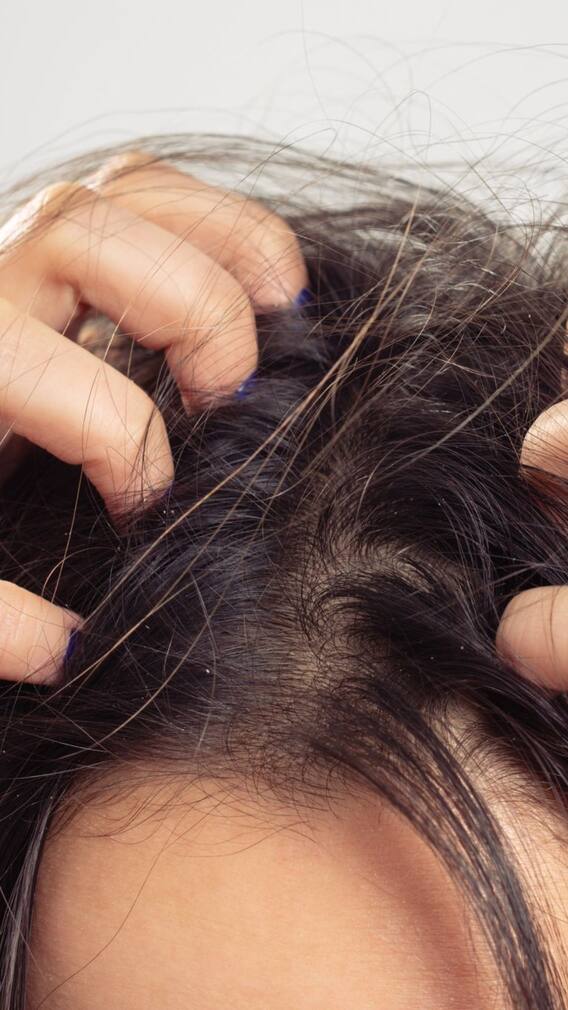 తలలో దురద ఎక్కువ వస్తుందా? అయితే ఇవి మీకోసమే