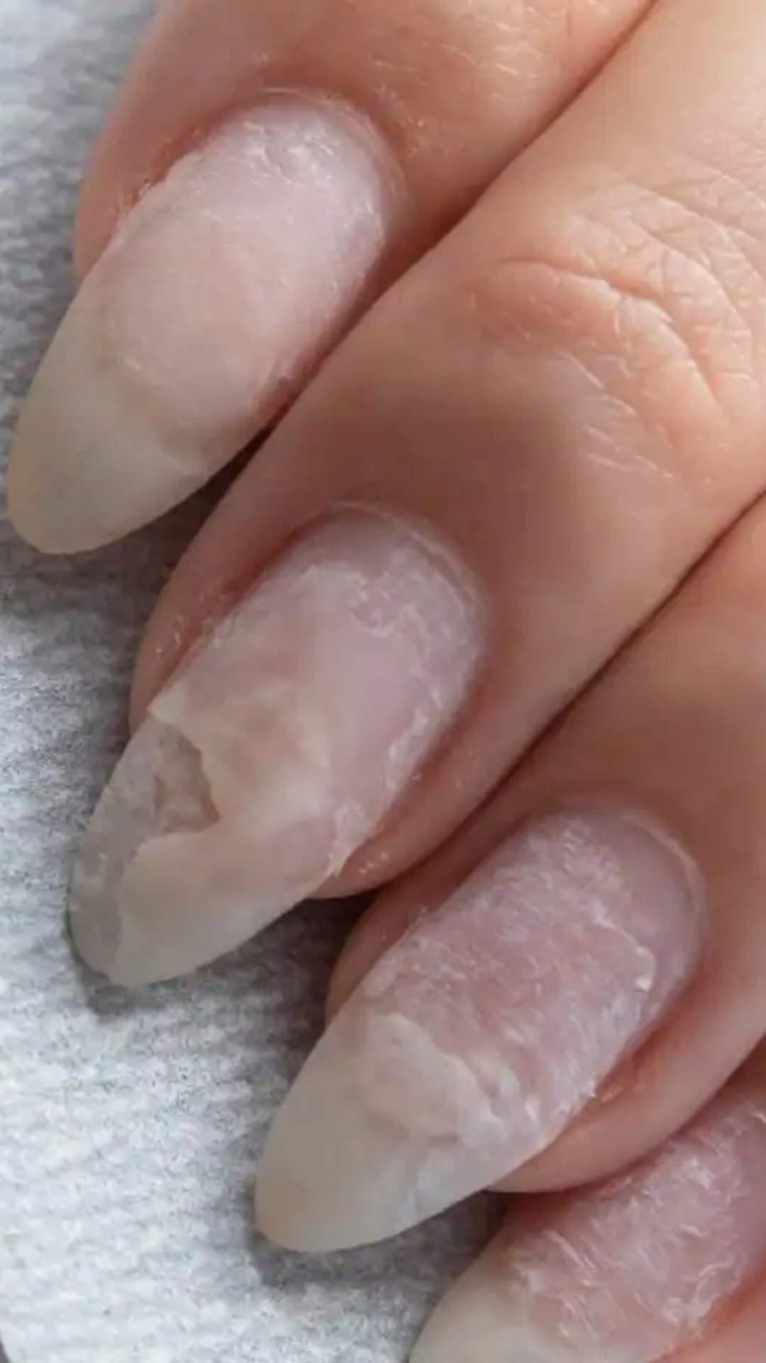 How To Get Rid Of Nail Fungus - Nail Care Tips : क्या आपके नाखूनों में फंगस  ने बना ली है जगह तो अपनाएं घरेलू उपाय, मिल जाएगा निजात | Lifestyle News In  Hindi