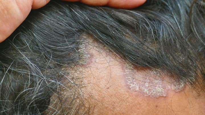 Seborrheic Dermatitis Common Skin Condition Scalp Itchy Scaly Causes Meaning Symptoms Treatment Prevention Seborrheic Dermatitis: How Does This Skin Condition Affect The Scalp? Know Symptoms, And Ways To Treat