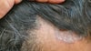 Seborrheic Dermatitis: How Does This Skin Condition Affect The Scalp? Know Symptoms, And Ways To Treat