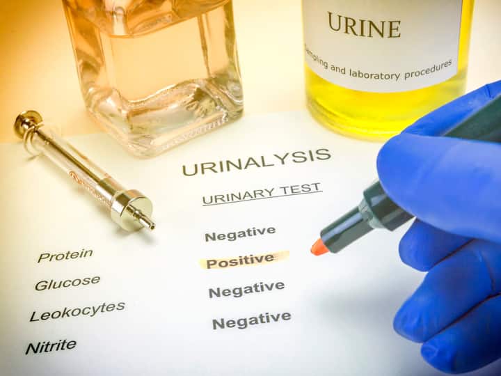 Urinalysis: Urinalysis involves testing a urine sample for various markers of kidney health, such as protein, blood, and other abnormalities. Proteinuria (the presence of protein in urine) and hematuria (blood in urine) are common signs of kidney damage and may indicate underlying kidney disease. (image source: getty images)