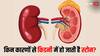 World Kidney Day: मरीज की किडनी से निकली 418 पथरी, इन कारणों से किडनी में हो जाती है स्टोन...जानें