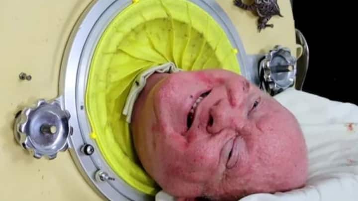 Paul Alexander Death Man in the Iron Lung Paul Alexander Dies at Age of 78 Paul Alexander: Polio-Infected Man Who Spent 70 Years Inside Iron Lung, Dies At 78
