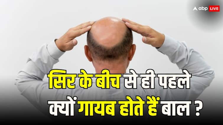 hair care tips hair loss in men causes and treatment in hindi सिर के बीचोबीच से ही सबसे पहले क्यों गायब होते हैं बाल, क्या आपको पता है इसकी वजह?