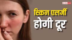 इन चीजों को डाइट में करें शामिल, स्किन एलर्जी रहेगी हमेशा दूर...कम दिनों में दिखेगा असर