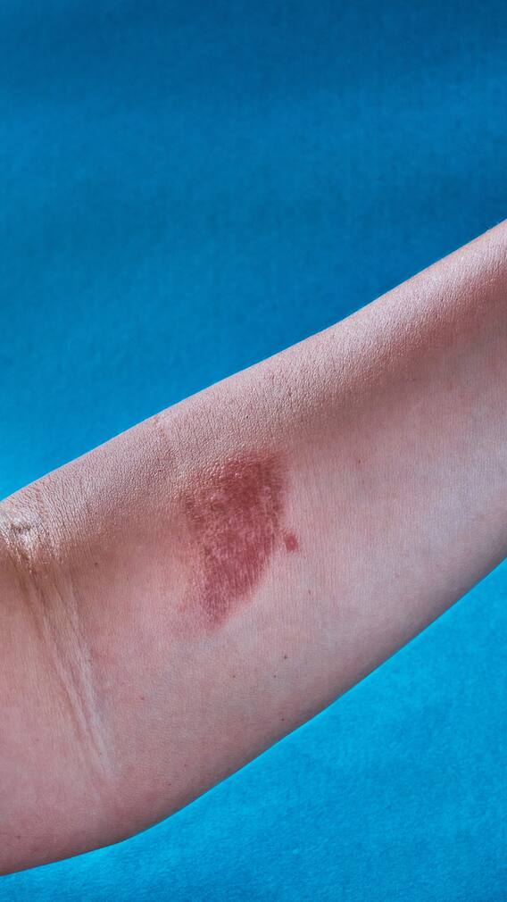 What Is Photophodermatitis? Know Symptoms And Prevention Tips