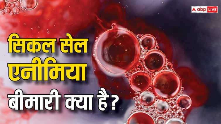 sickle cell anemia is one of a group of inherited disorders Symptoms and causes खून से जुड़ी गंभीर बीमारी सिकल सेल एनीमिया क्या है? लक्षणों को नजरअंदाज न करें वरना जा सकती है जान