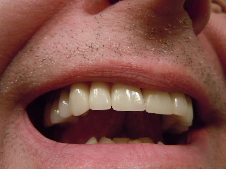 ज्यादा दवाइयों के उपयोग से भी दांत पीले पड़ने लगते हैं. यही नहीं अधिक मीठा खाने की वजह से भी दांतों पर पीली परत चढ़ती है.  कुछ घरेलू उपाय को कर के दांतों के पीलेपन की समस्या से निजात पा सकते हैं. जैसे बेकिंग सोडा एक प्राकृतिक दांतों को सफेद करने वाला पदार्थ माना जाता है.