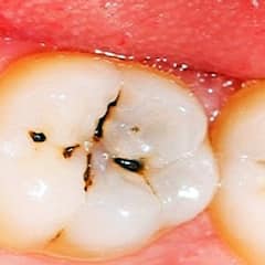 Teeth Care : ਕੀ ਤੁਸੀ ਵੀ ਹੋ ਦੰਦਾਂ ਨੂੰ ਕੀੜਾ ਲੱਗਣ 'ਤੇ ਪ੍ਰੇਸ਼ਾਨ, ਤਾਂ ਅਪਣਾਓ ਆਹ ਘਰੇਲੂ ਉਪਾਅ ਮਿਲੇਗੀ ਰਾਹਤ