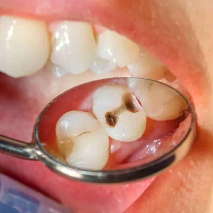 Teeth Care :  ਜ਼ਿਆਦਾ ਮਿਠਾਈਆਂ ਦਾ ਸੇਵਨ ਕਰਨਾ, ਦੰਦਾਂ ਦੀ ਸਫਾਈ ਨਾ ਕਰਨਾ ਅਤੇ ਸਮੇਂ ਸਿਰ ਪਲਾਕ ਤੋਂ ਛੁਟਕਾਰਾ ਨਾ ਪਾਉਣਾ ਦੰਦਾਂ ਦੇ ਸੜਨ ਦਾ ਕਾਰਨ ਬਣਦਾ ਹੈ। ਦੰਦਾਂ ਦੇ ਸੜਨ ਨੂੰ ਕੀੜਾ ਲੱਗਣਾ ਜਾਂ ਕੈਵਿਟੀ ਵੀ ਕਿਹਾ ਜਾਂਦਾ ਹੈ।