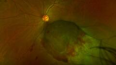 बिना चीर-फाड़ आंख के कैंसर का एम्स में हो रहा इलाज, अब तक 10 हजार मरीजों को मिला लाभ