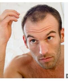 દિવસભર સોશિયલ મીડિયા પર એક્ટિવ રહેશો તો જલદી પડી જશે ટાલ, થયો ડરામણો ખુલાસો