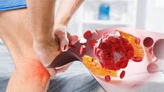 High Uric Acid: યુરિક એસિડમાં થયો છે વધારો તો આ ટ્રિક્સને કરો ફોલો, તરત થશે કંન્ટ્રોલ