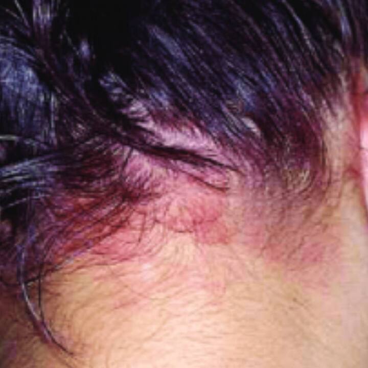 ਜੇਕਰ ਤੁਹਾਡੀ ਸਕੈਲਪ ਨੂੰ ਰੰਗ ਹੋ ਜਾਂਦਾ ਹੈ ਤਾਂ ਗੁਲਾਬ ਜਲ 'ਚ ਨਿੰਬੂ ਦੇ ਰਸ ਦੀਆਂ 5 ਬੂੰਦਾਂ ਮਿਲਾ ਕੇ ਕਾਟਨ ਬਾਲ ਦੀ ਮਦਦ ਨਾਲ ਸਾਫ਼ ਕਰੋ। ਨਿੰਬੂ ਨੂੰ ਕਦੇ ਵੀ ਸਿੱਧਾ ਨਾ ਲਗਾਓ।