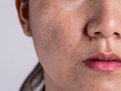 Skin Care: ਰਾਤ ਨੂੰ ਸੌਣ ਤੋਂ ਪਹਿਲਾਂ ਕਰ ਲਓ ਆਹ ਛੋਟਾ ਜਿਹਾ ਕੰਮ...ਚਿਹਰੇ ਦੇ ਸਾਰੇ ਪਿੰਪਲਸ ਹੋ ਜਾਣਗੇ ਸਾਫ਼