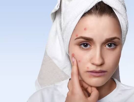 ਪਰ ਅੱਜ ਇਸ ਰਿਪੋਰਟ ਵਿੱਚ ਅਸੀਂ ਤੁਹਾਨੂੰ ਦੱਸਾਂਗੇ ਕਿ ਕਿਵੇਂ ਤੁਸੀਂ ਘਰੇਲੂ ਨੁਸਖਿਆਂ ਨਾਲ ਆਪਣੇ ਚਿਹਰੇ ਦੇ ਦਾਗ-ਧੱਬਿਆਂ ਨੂੰ ਘੱਟ ਕਰ ਸਕਦੇ ਹੋ। ਦੁੱਧ ਵਿੱਚ ਲੈਕਟਿਕ ਐਸਿਡ ਪਾਇਆ ਜਾਂਦਾ ਹੈ ਜੋ ਕਿ ਮੁਹਾਸੇ ਘੱਟ ਕਰਨ ਵਿੱਚ ਮਦਦ ਕਰਦਾ ਹੈ।