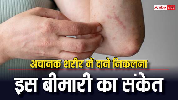 Skin Rashes: स्किन पर निकल आए हैं दाने तो न करें नजरअंदाज, वरना होना पड़ेगा परेशान