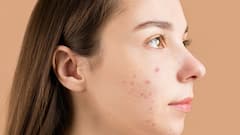 Acne Problems: গরমের মরশুমে বাড়তে পারে ব্রনর সমস্যা, এড়ানোর জন্য কী কী নিয়ম মেনে চলবেন, দেখে নিন
