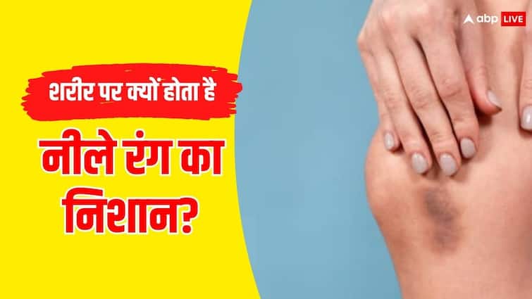 What causes unexplained bruising on the legs hand and other body part क्या आपके भी हाथ-पैर या शरीर के दूसरे हिस्से में दिखाई देते हैं चोट लगने जैसा निशान? जानें कारण