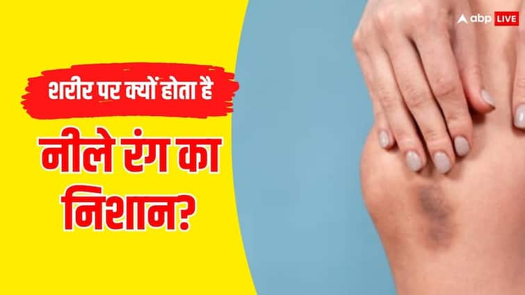 क्या आपके भी हाथ-पैर या शरीर के दूसरे हिस्से में दिखाई देते हैं चोट लगने जैसा निशान? जानें कारण What causes unexplained bruising on the legs hand and other body part क्या आपके भी हाथ-पैर या शरीर के दूसरे हिस्से में दिखाई देते हैं चोट लगने जैसा निशान? जानें कारण