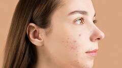 Acne Problems: গরমের মরশুমে বাড়তে পারে ব্রনর সমস্যা, এড়ানোর জন্য কী কী নিয়ম মেনে চলবেন, দেখে নিন
