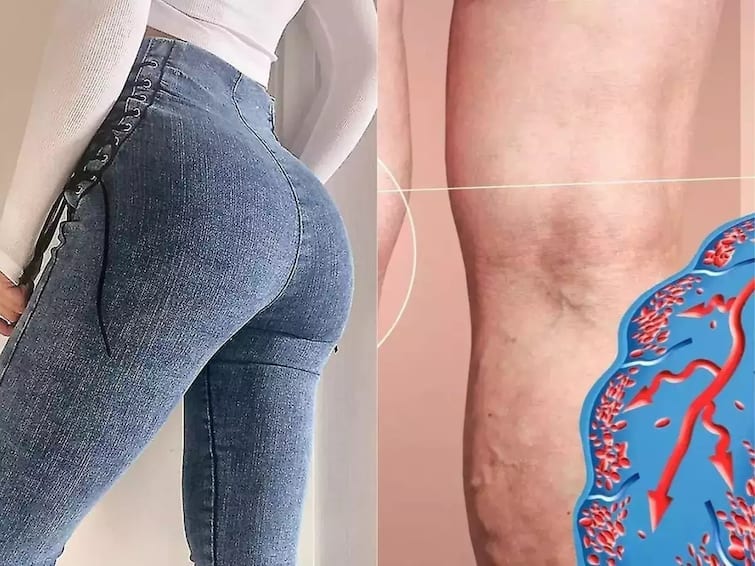 Do you also like to wear tight jeans  So be careful,  skin cancer   can be  happen Health : શું આપ પણ ટાઇટ જિન્સ પહેવાનું કરો છો પસંદ? તો સાવધાન, થઇ શકે છે આ જીવલેણ બીમારી