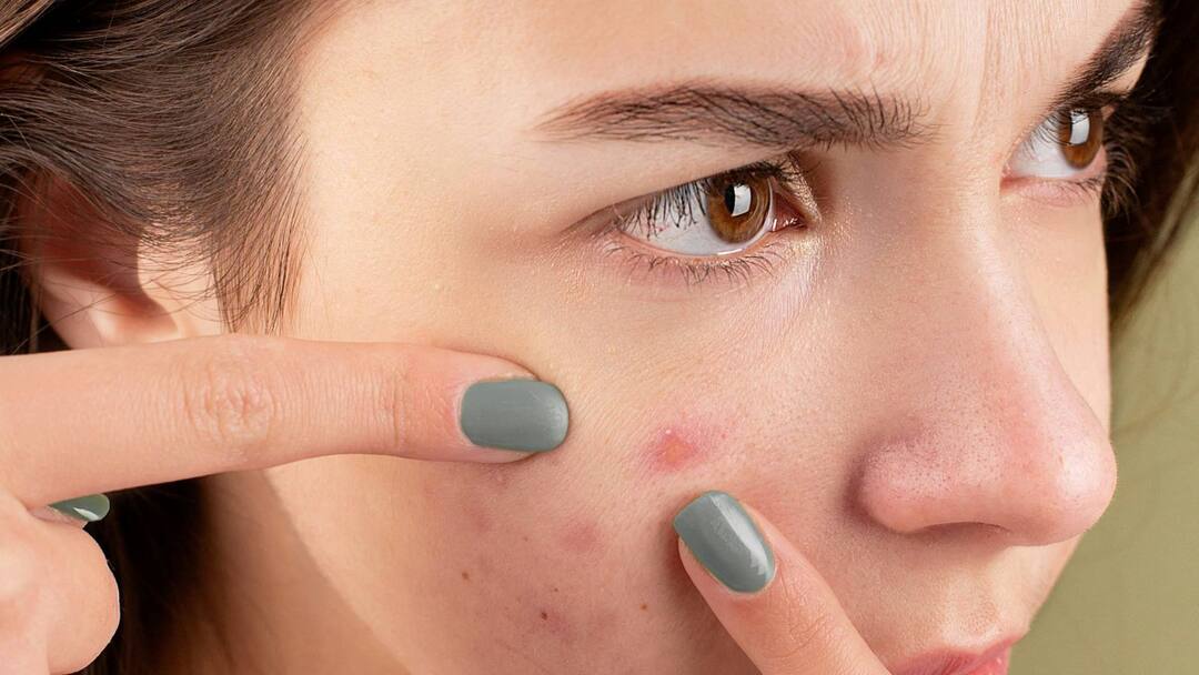 Acne Problems in Summer: গরমকালে ব্রনর সমস্যা কমানোর জন্য কী কী নিয়ম মেনে চললে উপকার পাবেন আপনি ? Acne Problem in Summer Days How to Prevent this Problem Here are some Easy Tips for You Acne Problems in Summer: গরমকালে ব্রনর সমস্যা কমানোর জন্য কী কী নিয়ম মেনে চললে উপকার পাবেন আপনি ?