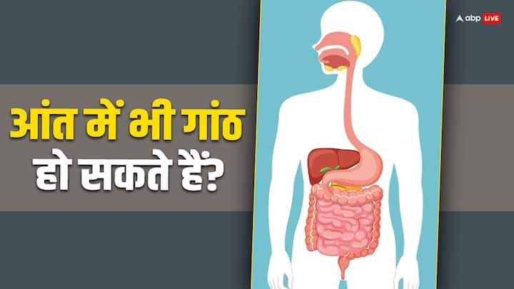 Gut Health: कुछ लोग आंत हो या किसी भी जगह हुए गांठ को अनदेखा कर देते हैं. लेकिन अगर इसका वक्त रहते इलाज नहीं किया गया तो यह गंभीर बीमारी का रूप ले सकती है.