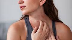 Summer Health Tips: গরম পড়তেই ঘামাচির সমস্যা, রেহাই পাওয়ার ৮ ঘরোয়া উপায়