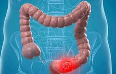 શરીર પર જોવા મળતા આ લક્ષણો સૂચવે છે કે આંતરડામાં ગાંઠ છે, આ રીતે કરો ઓળખ