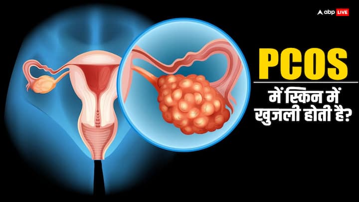 PCOS Cause Dryness: पीसीओएस से पीड़ित महिलाओं की स्किन काफी ज्यादा ड्राई हो जाती है. जिसके कारण उनके स्किन का ग्लो खत्म होने लगता है.