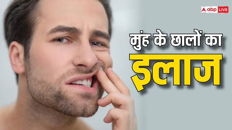 facing mouth ulcers problem then do these home remedies मुंह के छाले की वजह से खाने में हो रही है दिक्कत? तो इन घरेलू नुस्खों को आज से करें ट्राई