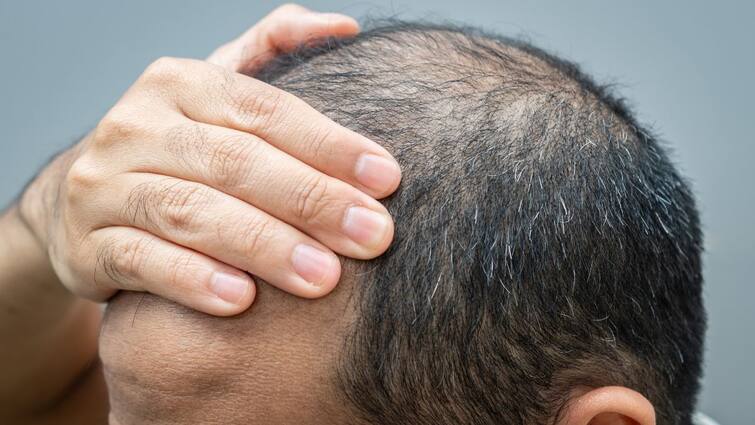 Best Hair Loss Products In India Regain Your Confidence Top 5 Hair Loss Solutions for the Modern Indian Man SKML Regain Your Confidence: Top 5 Hair Loss Solutions For The Modern Indian Man